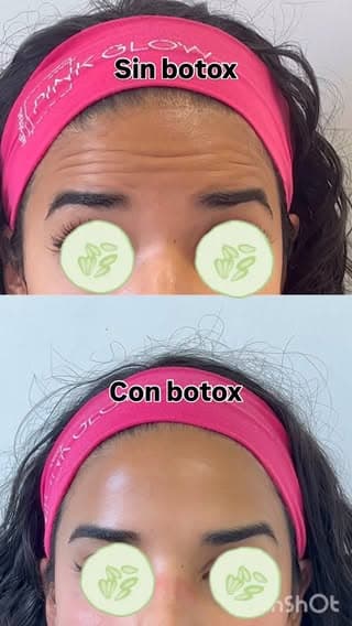 Comparativa antes y después de aplicación de toxina botulínica